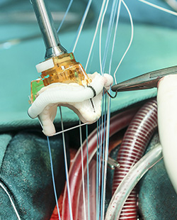 Aortic Valve Replacement/ Mitral Valve Replacement